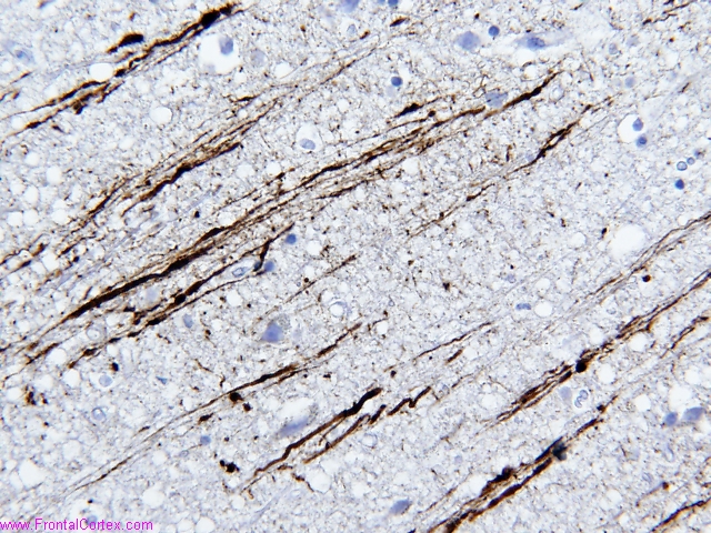 Axonal injury, beta amyloid precursor protein immunohistochemistry